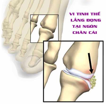 Bệnh GOUT và chế độ dinh dưỡng - Bệnh viện Hoàn Mỹ Sài Gòn