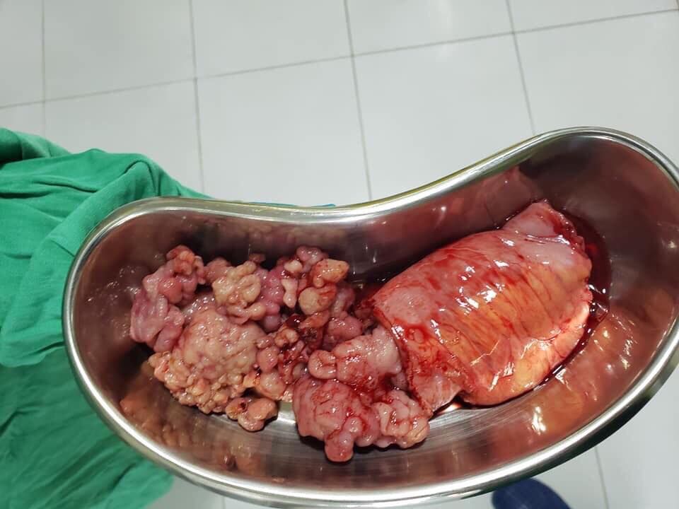 Cứu sống người bệnh bị tắc ruột non do hội chứng PJS(Peutz Jeghers) - Bệnh viện Hoàn Mỹ Sài Gòn