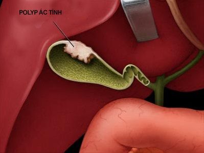 Bệnh polyp túi mật - Bệnh viện Hoàn Mỹ Sài Gòn