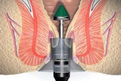 Bệnh trĩ và phẫu thuật LONGO - Bệnh viện Hoàn Mỹ Sài Gòn