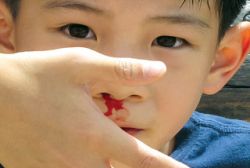 Bệnh mùa nóng: Chảy máu cam ở trẻ nhỏ - Bệnh viện Hoàn Mỹ Sài Gòn