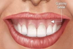 Điều trị hở lợi phụ thuộc tuỳ thuộc theo từng nguyên nhân - Bệnh viện Hoàn Mỹ Sài Gòn