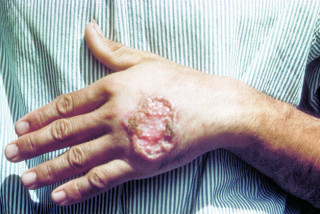 Bệnh nhiễm Leishmania - Bệnh viện Hoàn Mỹ Sài Gòn