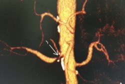 Đặt Stent thành công cho bệnh nhân hẹp động mạch thận - Bệnh viện Hoàn Mỹ Sài Gòn