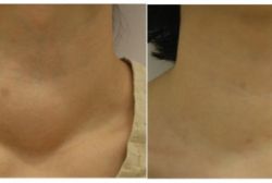 ĐỐT SÓNG CAO TẦN ĐIỀU TRỊ BƯỚU LÀNH TUYẾN GIÁP KHÔNG CẦN PHẪU THUẬT TẠI BỆNH VIỆN HOÀN MỸ