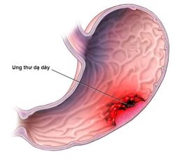 Ung thư dạ dày - Bệnh viện Hoàn Mỹ Sài Gòn