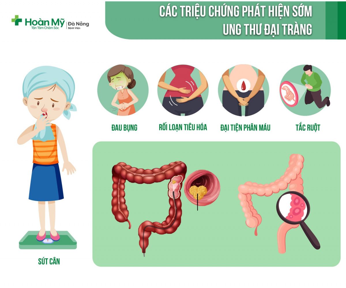 Ung thư đại trực tràng - Bệnh viện Hoàn Mỹ Sài Gòn