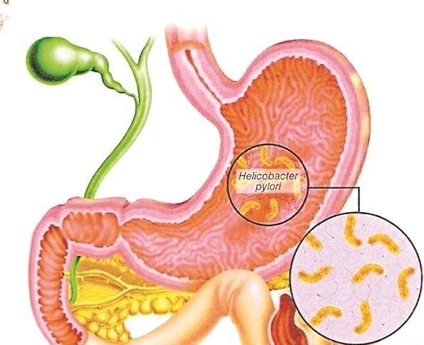 Viêm Dạ Dày - Tá Tràng: Nguyên nhân và cách điều trị - Bệnh viện Hoàn Mỹ Sài Gòn
