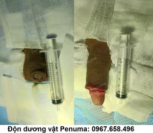 Độn mô da làm to dài cậu nhỏ, nam khoa Penuma - ca 10