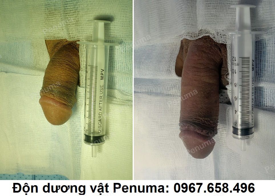 Tăng kích thước cậu nhỏ bằng phẫu thuật độn dương vật, nam khoa Penuma - ca 11