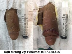 Tăng kích thước dương vật, nam khoa Penuma - ca 13