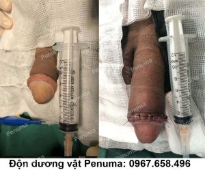 Độn mô da nhân tạo làm to dài dương vật, nam khoa Penuma - ca 14