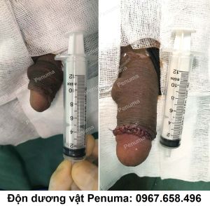 Tăng kích thước cậu nhỏ bằng độn dương vật Penuma - ca 15