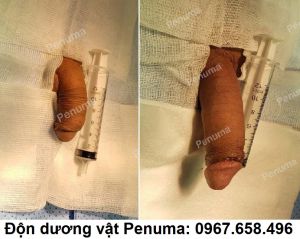 Độn dương vật Penuma - ca 16