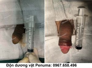 Tăng kích thước dương vật, nam khoa Penuma - ca 17