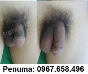 Tăng kích thước dương vật bằng độn mô da nhân tạo, nam khoa Penuma - ca 4