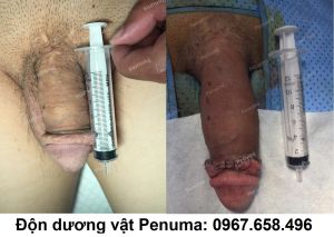 Đặt mô da nhân tạo làm to, dài dương vật, nam khoa Penuma - ca 5