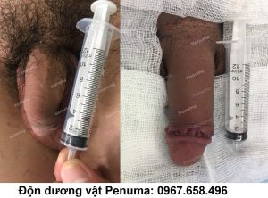 Độn mô da nhân tạo làm to dài dương vật, nam khoa Penuma - ca 6