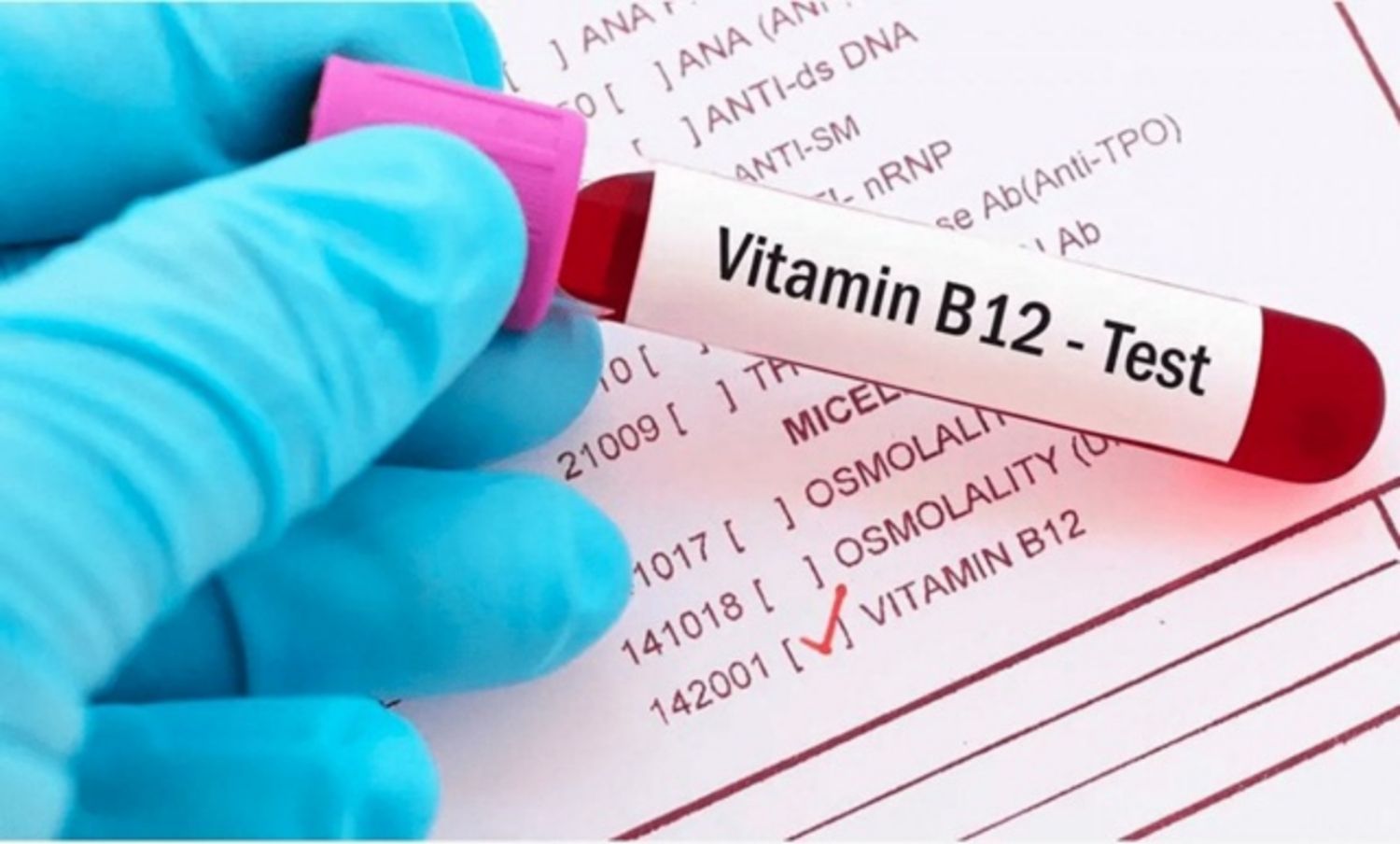 Khi nào cần làm xét nghiệm vitamin B12?
