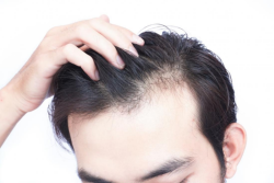 Bổ sung biotin có phải giải pháp trị hói ở nam giới?