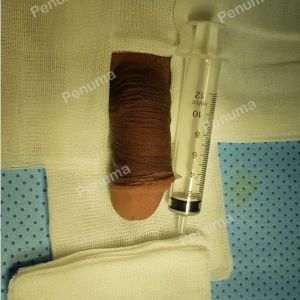 Đặt mô da nhân tạo tăng kích thước dương vật, nam khoa Penuma - Ca 18
