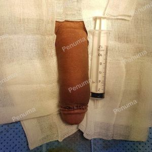 Đặt mô da nhân tạo tăng kích thước dương vật, nam khoa Penuma - Ca 18