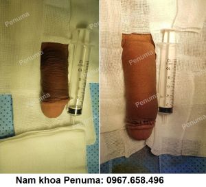 Đặt mô da nhân tạo tăng kích thước dương vật, nam khoa Penuma - Ca 18