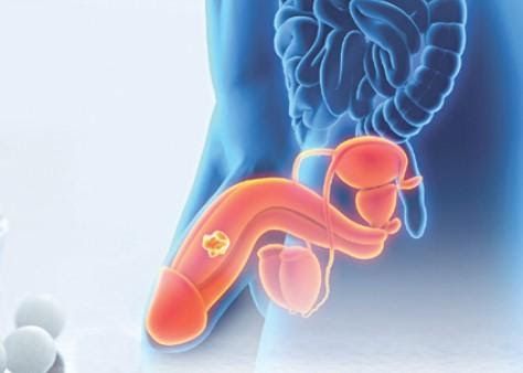 Ăn uống đúng cách giúp phòng, chống  ung thư dương vật  - Nam khoa Penuma