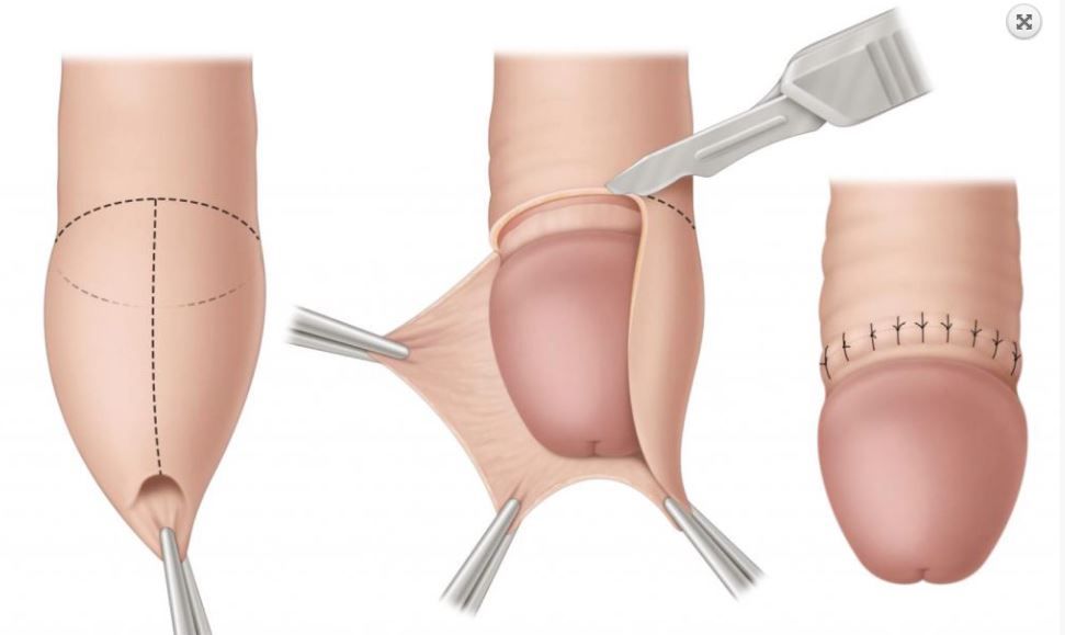 Cắt bao quy đầu cho trẻ em: lợi ích và những câu hỏi thường gặp - Nam khoa Penuma