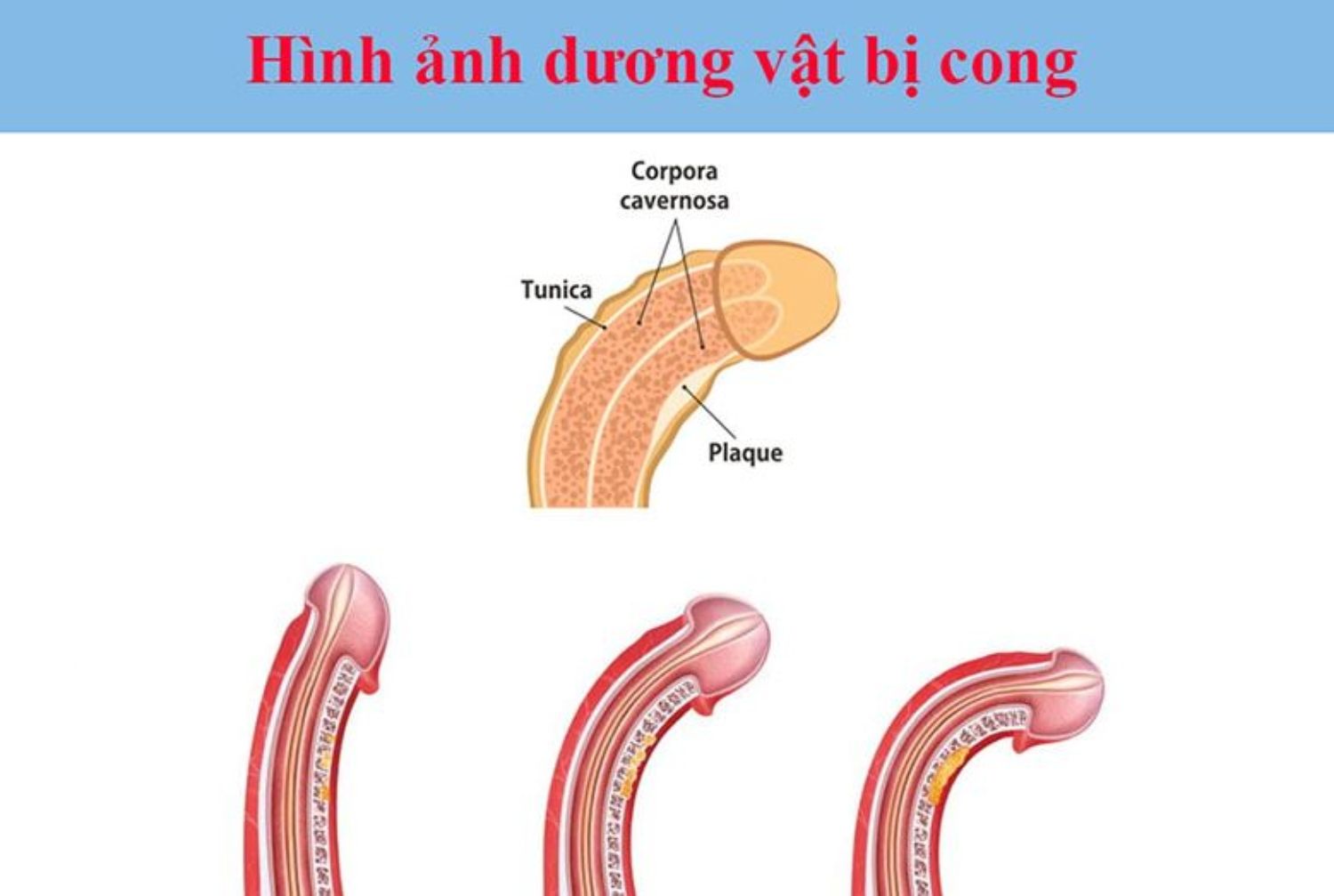 Có loại thuốc nào điều trị cong vẹo dương vật? - Nam khoa Penuma