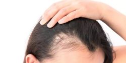 Mức ferritin thấp có thể gây rụng tóc