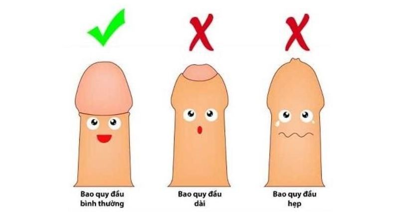 Hẹp bao quy đầu có thể dẫn tới ung thư dương vật - Nam khoa Penuma