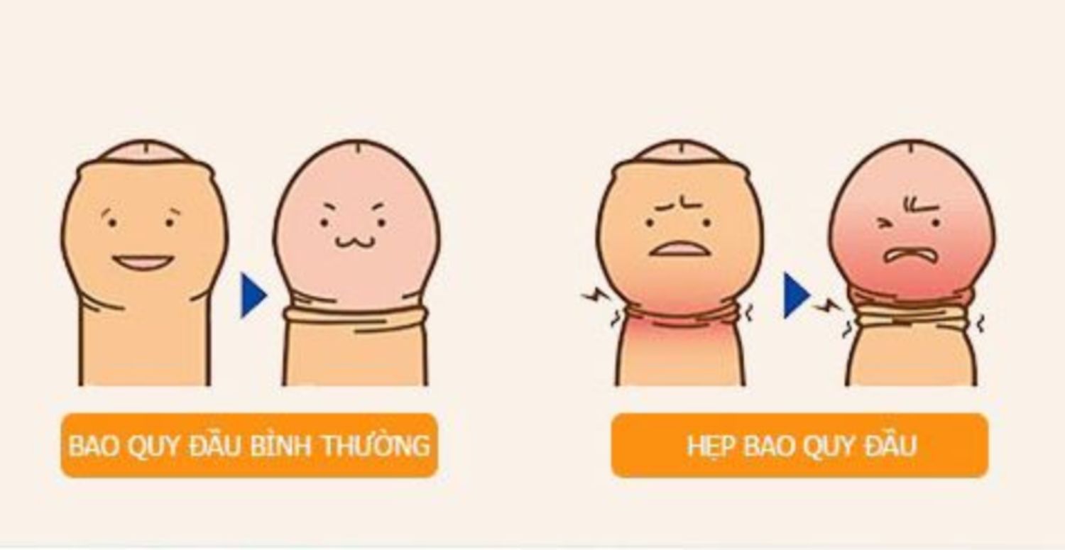 Hẹp bao quy đầu- nguyên nhân hàng đầu gây ung thư dương vật - Nam khoa Penuma