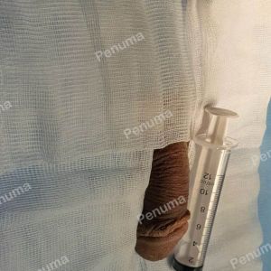 Đặt mô da nhân tạo tăng kích thước dương vật, nam khoa Penuma - ca 20