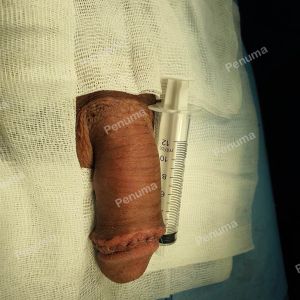 Đặt mô da nhân tạo tăng kích thước dương vật, nam khoa Penuma - ca 20
