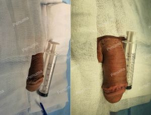 Đặt mô da nhân tạo tăng kích thước dương vật, nam khoa Penuma - ca 20