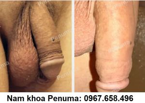 Đặt miếng độn Penuma tăng kích thước dương vật, khách hàng Mỹ - ca 21