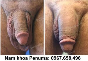 Đặt tấm độn Penuma tăng kích thước cậu nhỏ, khách hàng Mỹ - ca 22