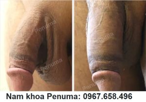 Đặt miếng độn Penuma là to dài cậu nhỏ, khách hàng Mỹ - ca 23