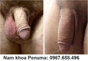 Đặt tấm độn Penuma, khách hàng Mỹ - ca 24