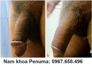 Tăng kích thước cậu nhỏ bằng tấm độn Penuma, khách hàng Mỹ - ca 26