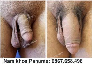 Tăng kích thước dương vật bằng tấm độn Penuma, khách hàng Mỹ - ca 27