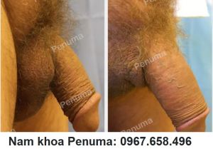 Đặt miếng Penuma làm dài & to dương vật, khách hàng Mỹ - ca 32