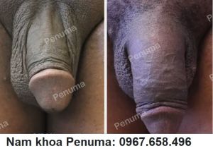Làm to & làm dài dương vật bằng đặt tấm độn Penuma, khách hàng Mỹ - ca 33