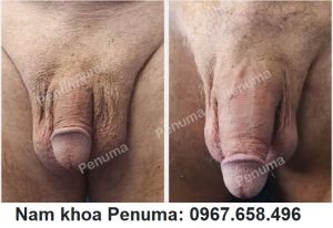Đặt miếng độn Penuma làm to và làm dài cậu nhỏ, khách hàng Mỹ- ca 38