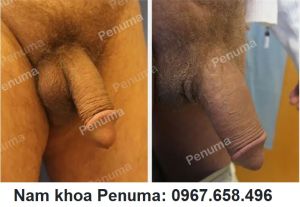 Tăng kích thước dương vật bằng miếng độn Penuma, khách hàng Mỹ - ca 40
