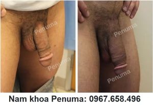 Đặt tấm độn Penuma làm to và dài dương vật, khách hàng Mỹ - ca 46
