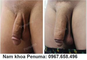 Làm to & dài dương vật bằng độn tấm Penuma, khách hàng Mỹ - ca 50