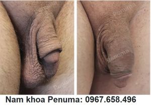 Làm dài & to dương vật bằng miếng độn Penuma, khách hàng Mỹ - ca 51