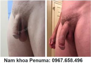 Tăng kích thước dương vật bằng đặt tấm độn Penuma, khách hàng Mỹ - ca 52
